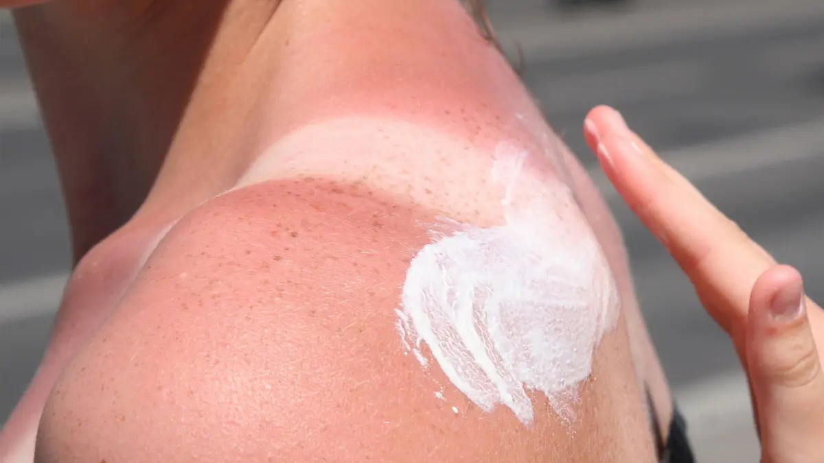 ARCHIV - Zum Themendienst-Gespräch vom 18. Juni 2021: Hier kommt die Sonnencreme zu spät, die Haut ist schon verbrannt. Was hilft nun noch? Foto: Stephanie Pilick/dpa/dpa-tmn - Honorarfrei nur für Bezieher des dpa-Themendienstes +++ dpa-Themendienst +++